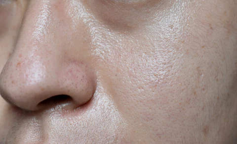 oily_skin_face